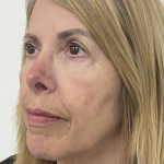 Nouvaderm Before & After Patient #3757