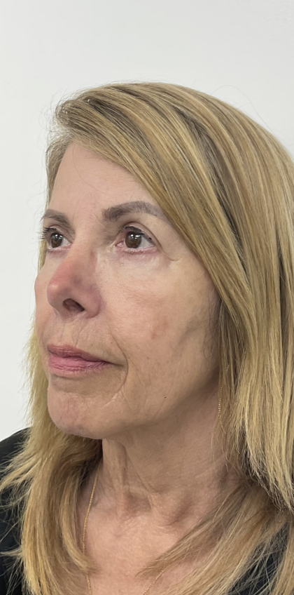 Nouvaderm Before & After Patient #3757