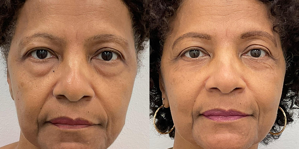 Before and After