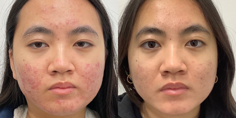 Before and After