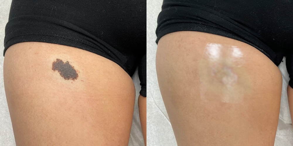 Before and After