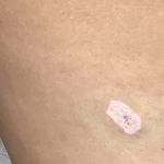 Mole Removal Before & After Patient #3729