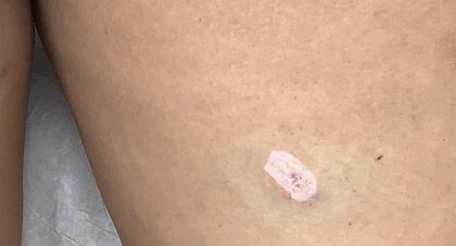 Mole Removal Before & After Patient #3729