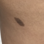Mole Removal Before & After Patient #3729
