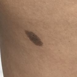 Mole Removal Before & After Patient #3729