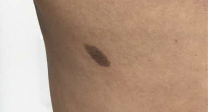 Mole Removal Before & After Patient #3729