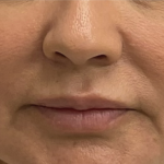 Lip Fillers Before & After Patient #3764