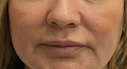 Lip Fillers Before & After Patient #3764
