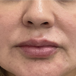 Lip Fillers Before & After Patient #3764
