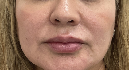 Lip Fillers Before & After Patient #3764