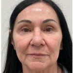 XERF Before & After Patient #4023