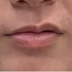 Lip Fillers Before & After Patient #4096