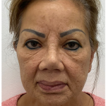 Lips Silicone Removal Before & After Patient #4083