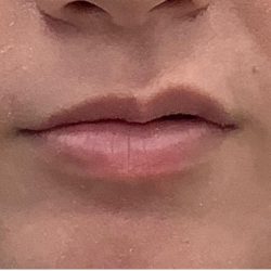 Lip Fillers Before & After Patient #4096
