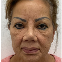 Lips Silicone Removal Before & After Patient #4083