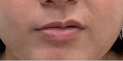 Lip Fillers Before & After Patient #4096