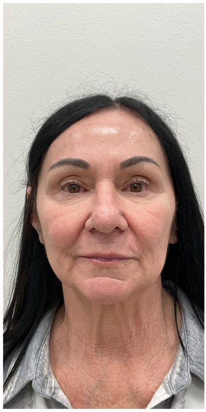 XERF Before & After Patient #4023