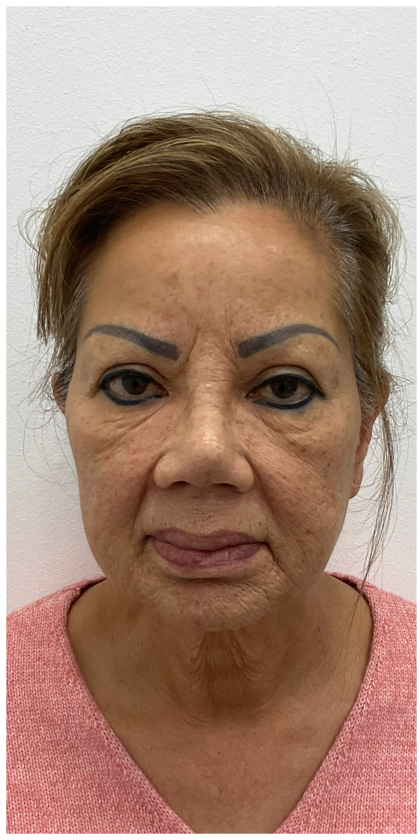 Lips Silicone Removal Before & After Patient #4083