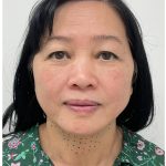 Kybella Before & After Patient #3996