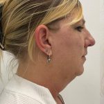 Kybella Before & After Patient #4092