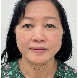 Kybella Before & After Patient #3996