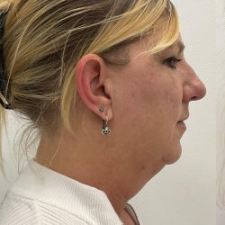 Kybella Before & After Patient #4092