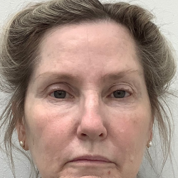 Sculptra Before & After Patient #4049