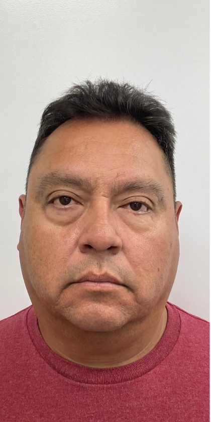 Lower Blepharoplasty Before & After Patient #4044