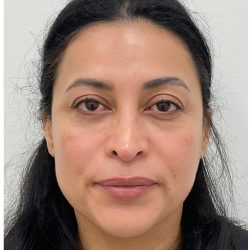 XERF Before & After Patient #4058