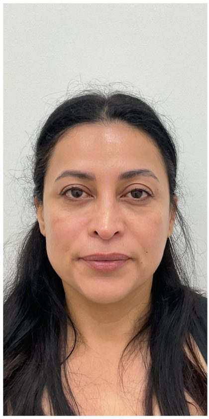 XERF Before & After Patient #4058