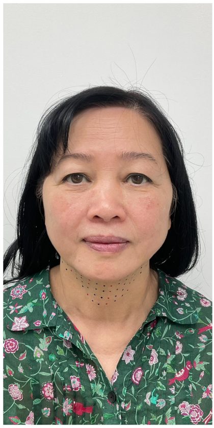 Kybella Before & After Patient #3996