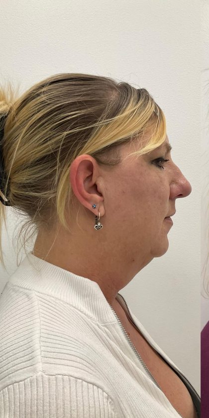 Kybella Before & After Patient #4092