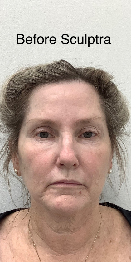 Sculptra Before & After Patient #4049