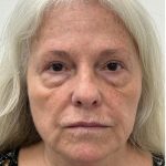 Lower Blepharoplasty Before & After Patient #4074