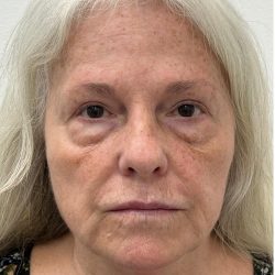 Lower Blepharoplasty Before & After Patient #4074