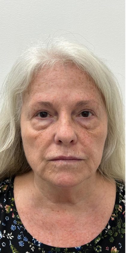 Lower Blepharoplasty Before & After Patient #4074