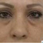 Under Eye Fillers Before & After Patient #4115