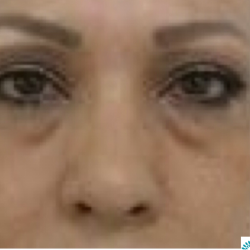 Under Eye Fillers Before & After Patient #4115