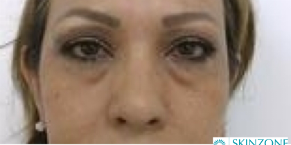 Under Eye Fillers Before & After Patient #4115