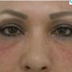 Under Eye Fillers Before & After Patient #4115