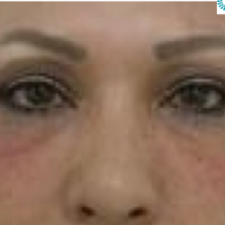 Under Eye Fillers Before & After Patient #4115