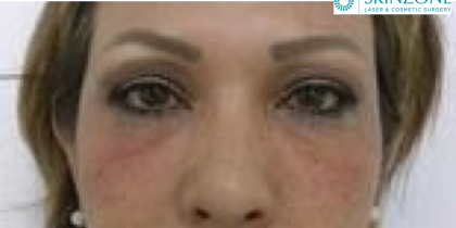 Under Eye Fillers Before & After Patient #4115