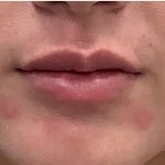 Lip Fillers Before & After Patient #4096