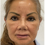 Lips Silicone Removal Before & After Patient #4083