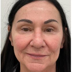 XERF Before & After Patient #4023