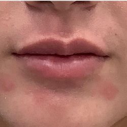 Lip Fillers Before & After Patient #4096