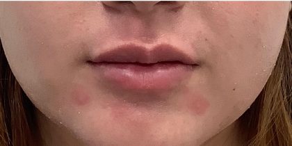 Lip Fillers Before & After Patient #4096