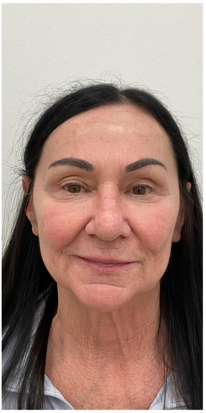 XERF Before & After Patient #4023