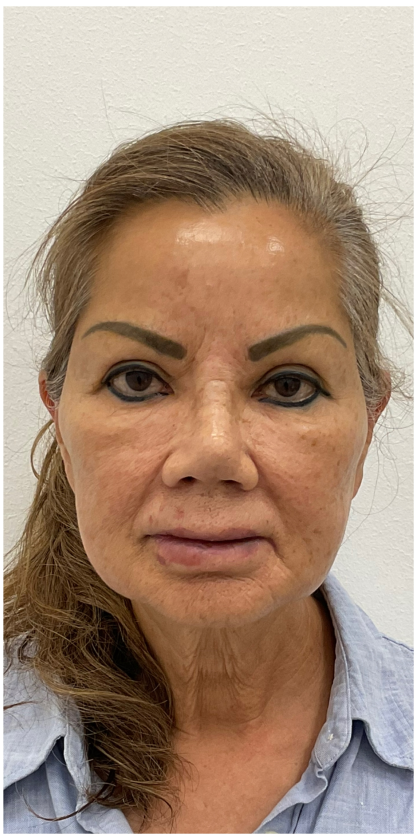 Lips Silicone Removal Before & After Patient #4083