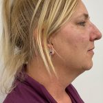 Kybella Before & After Patient #4092